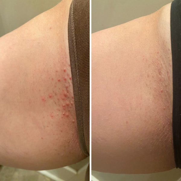 Bushbalm Ingrown Hair + Pre-Post Wax Oil